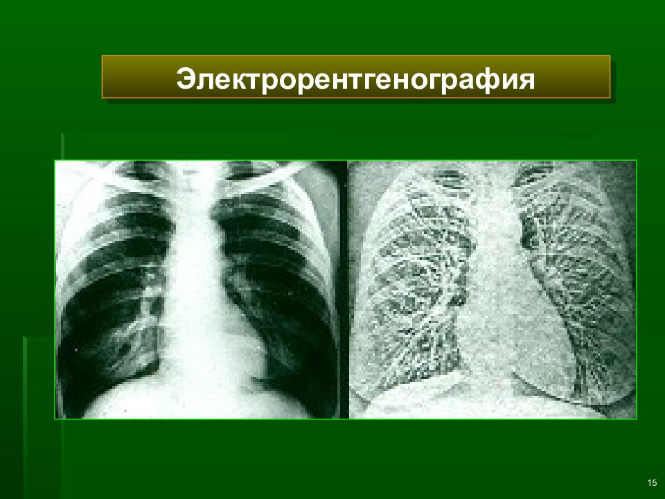 Лучевая диагностика легких презентация