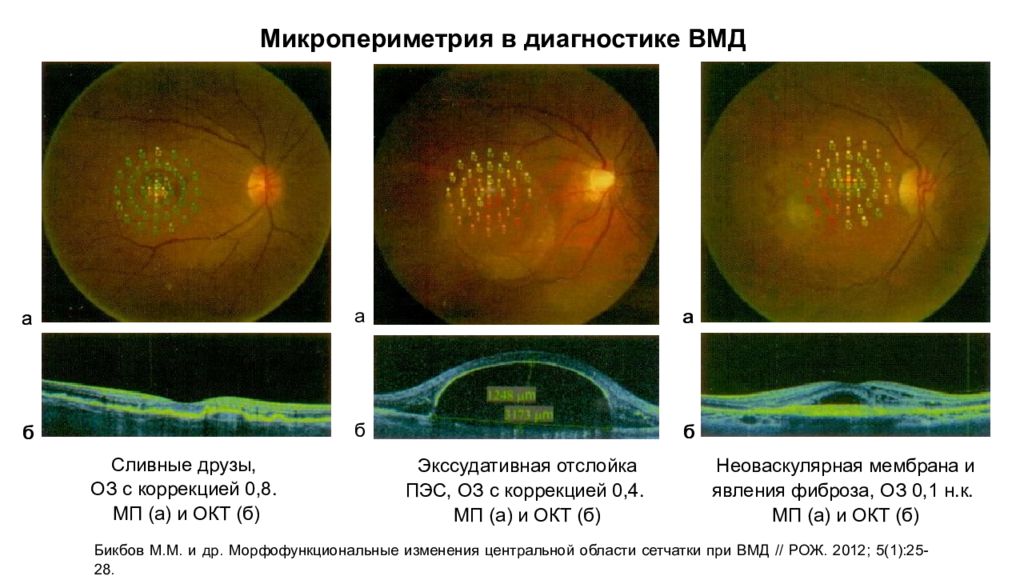 Возрастная макулярная дегенерация презентация