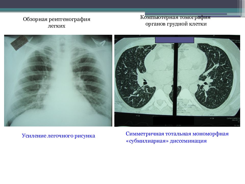 Легочный рисунок рентген. Рентген кт легких. Рентген и кт легких разница. Обзорная рентгенограмма легких. Рентген томограмма легких.