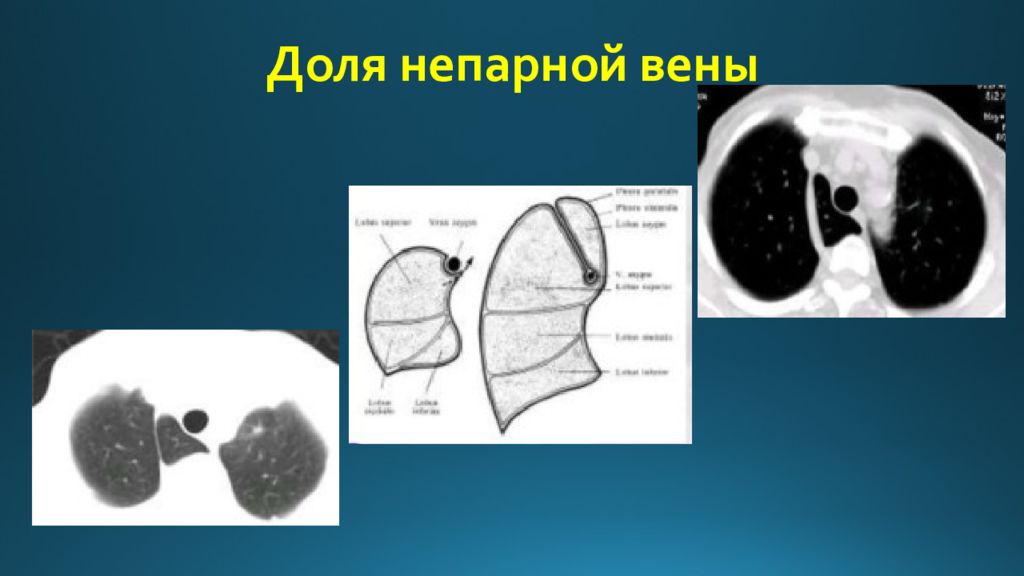 Непарная вена легких