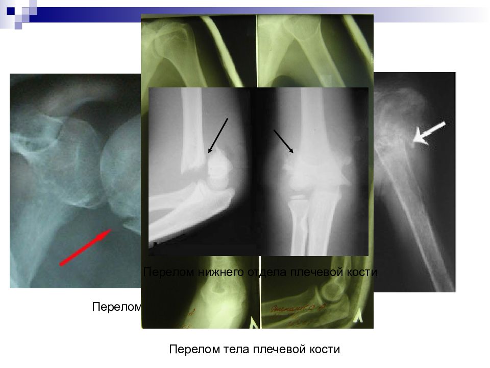 Переломы плечевой кости травматология презентация