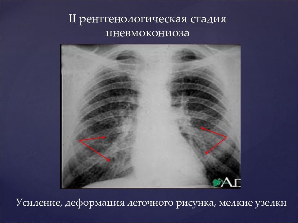 Пневмокониозы рентгенологическая картина