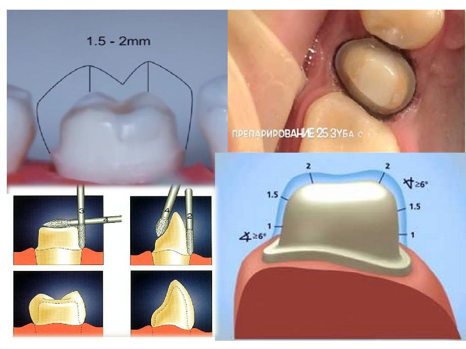 Препарирование под металлокерамическую коронку с уступом в картинках