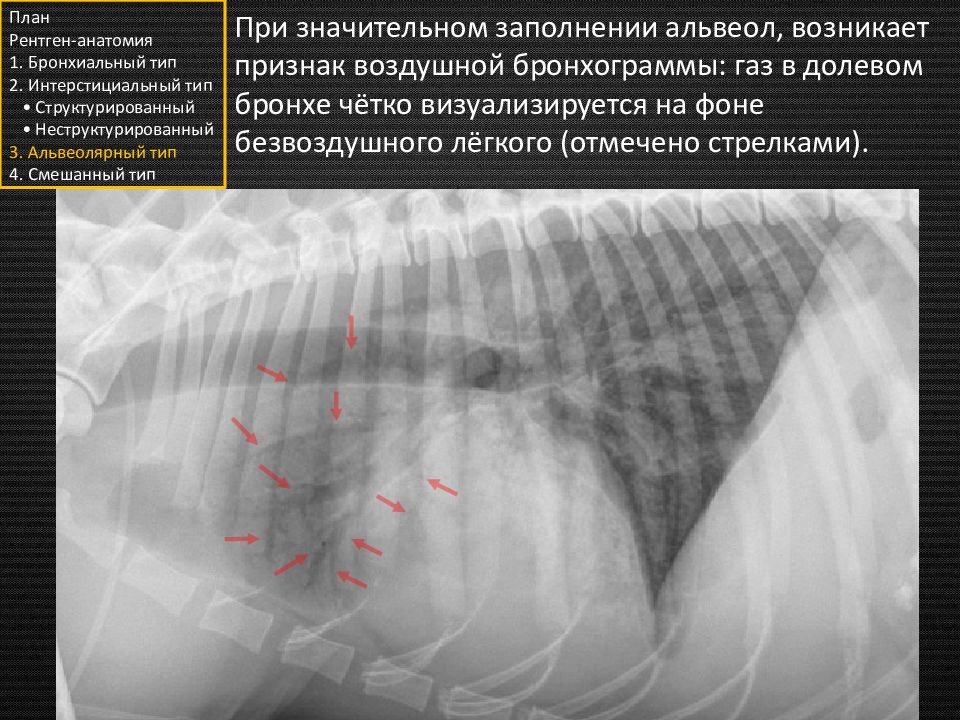 Рентгенсисптом аощдушной бронхографии. Признаки воздушной бронхографии. Симптом воздушной бронхографии рентген. Синдром воздушной бронхографии характерен для. Симптом воздушной бронхографии рентген.