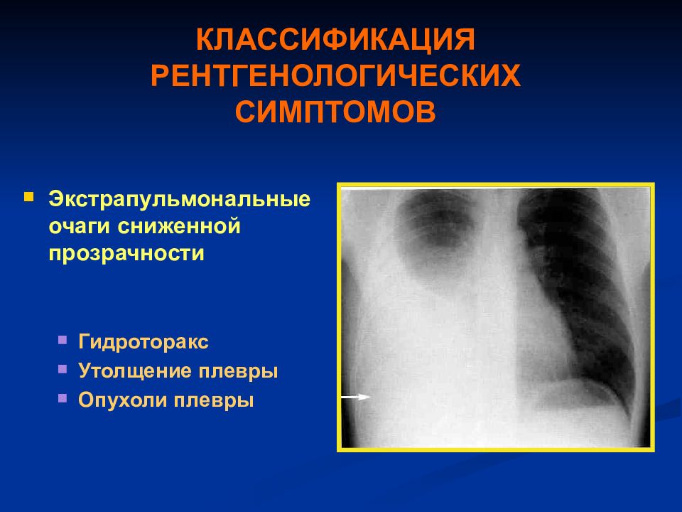 Признаки гидроторакса. Классификация гидроторакса рентген. Гидроторакс рентгенологическая классификация. Рентгенодиагностика гидроторакса. Рентгенологические симптомы гидроторакса.