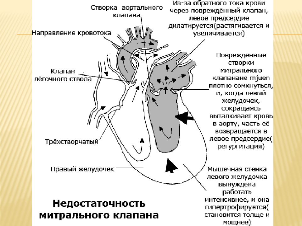 Аускультативная картина недостаточности митрального клапана характеризуется