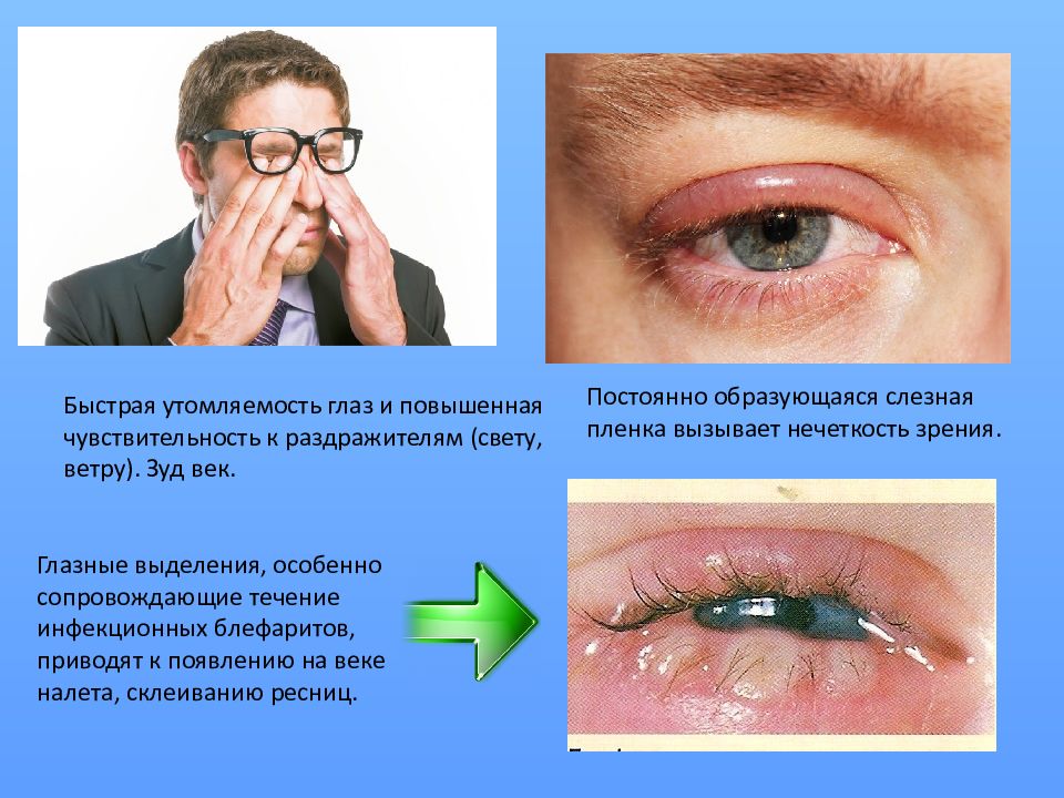 Блефарит — презентация