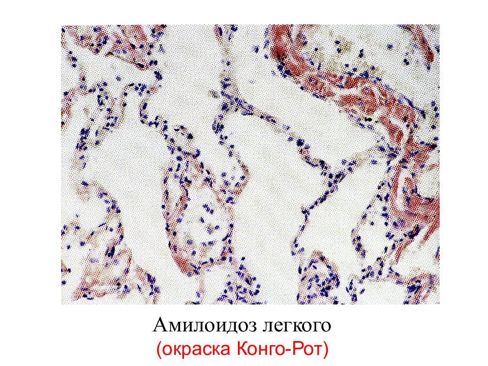 Патологическая анатомия лекции. Амилоид патологическая анатомия. Первичный бронхолегочный амилоидоз. Амилоидоз патанатомия. Амилоидоз легкого патанатомия.