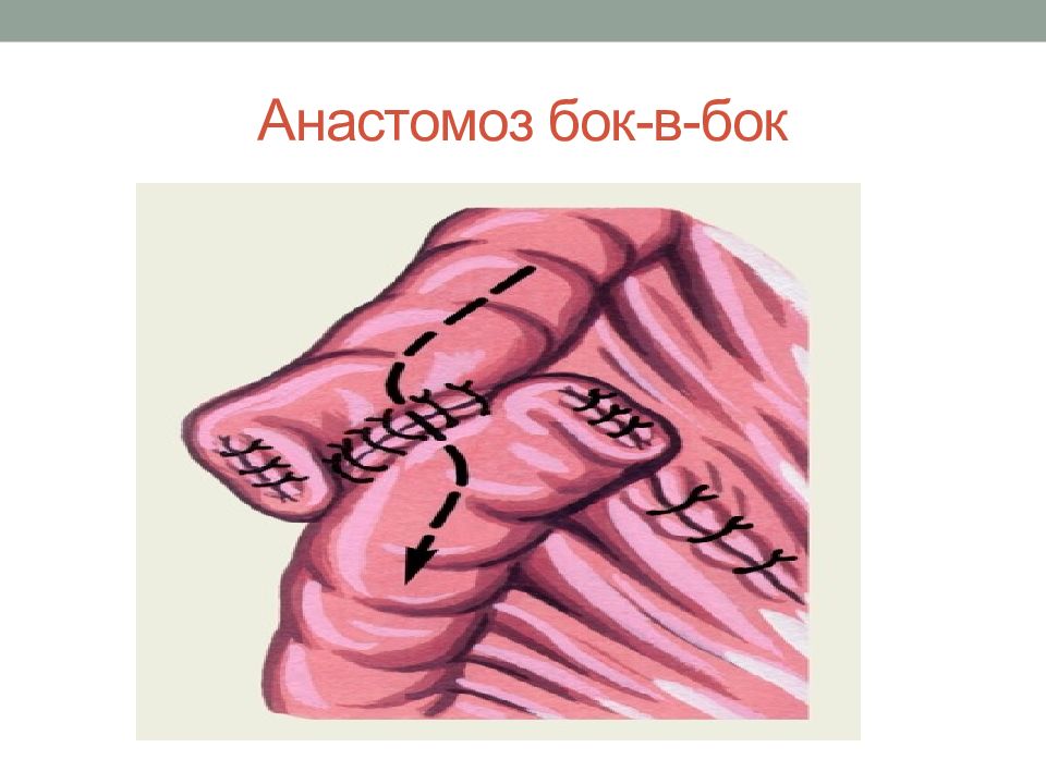 Анастомоз конец в конец. Анастомоз кишечника бок в бок. Энтероэнтероанастомоз бок в бок.
