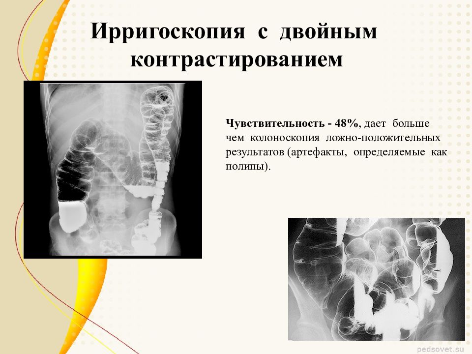 Ирригоскопия что это за процедура. Ирригоскопия Толстого кишечника рентген. Ирригоскопия двойное контрастирование. Рентгенологическое исследование Толстого кишечника (ирригоскопия)..