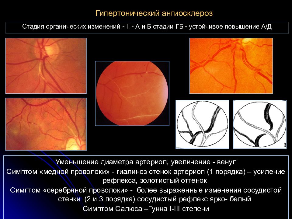 Гипертоническая ангиопатия презентация
