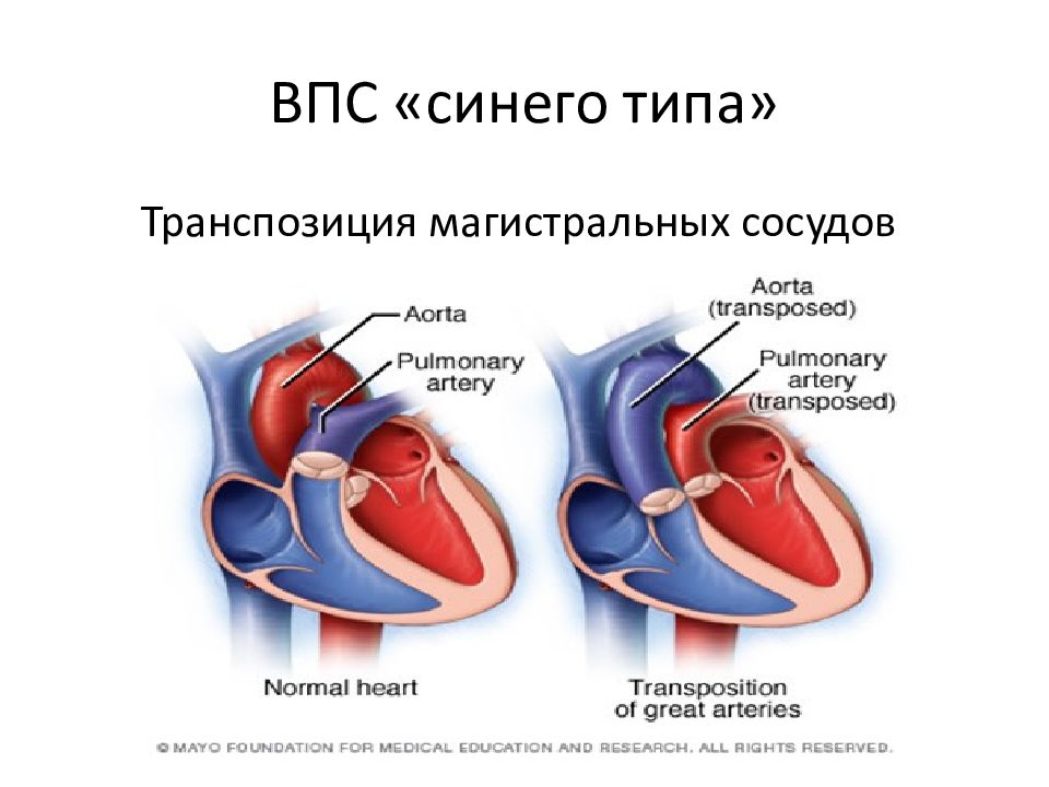 Врожденные пороки сердца презентация по педиатрии