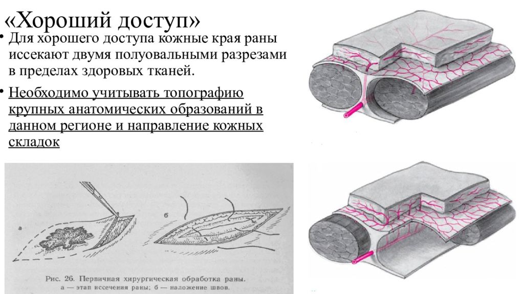 Первичные хирургические раны. Первичная хирургическая обработка РАН мягких тканей. Рубленная рана хирургическая обработка. Обработка кожных краев раны.