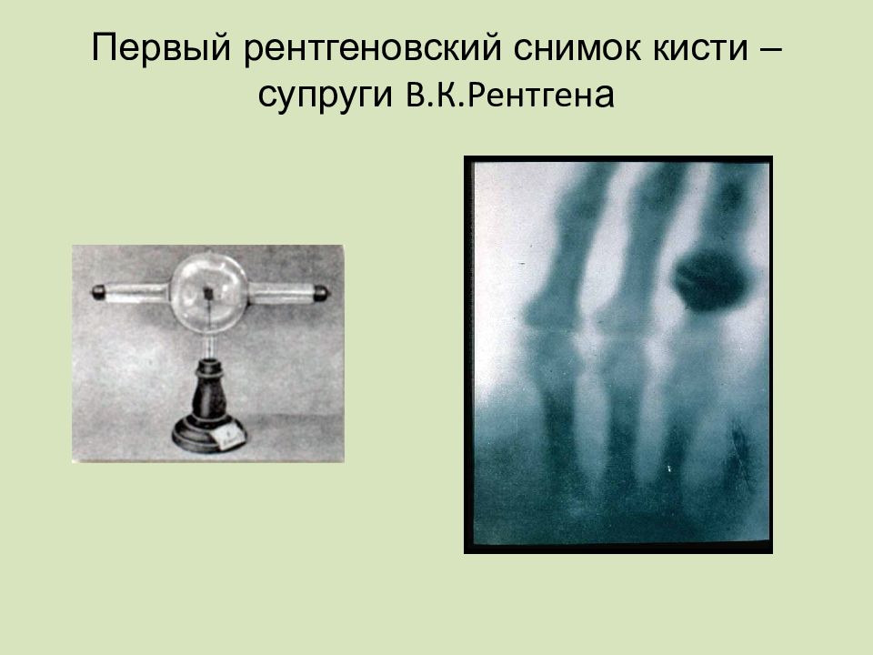 1 рентгеновский снимок. Первый снимок рентгена. Первыйренгеновский сниморк. Первый рентгеновский снимок и современный. Рентгеновский снимок жены рентгена.