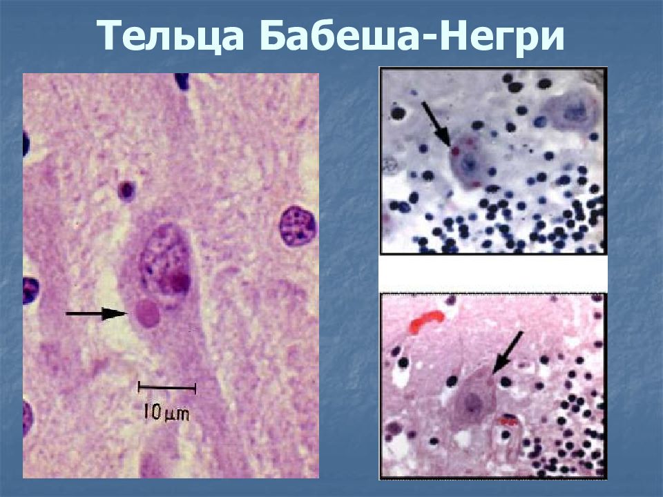 Тельца негри. Вирус бешенства тельца Бабеша негри. Внутриклеточные включения Бабеша-негри.