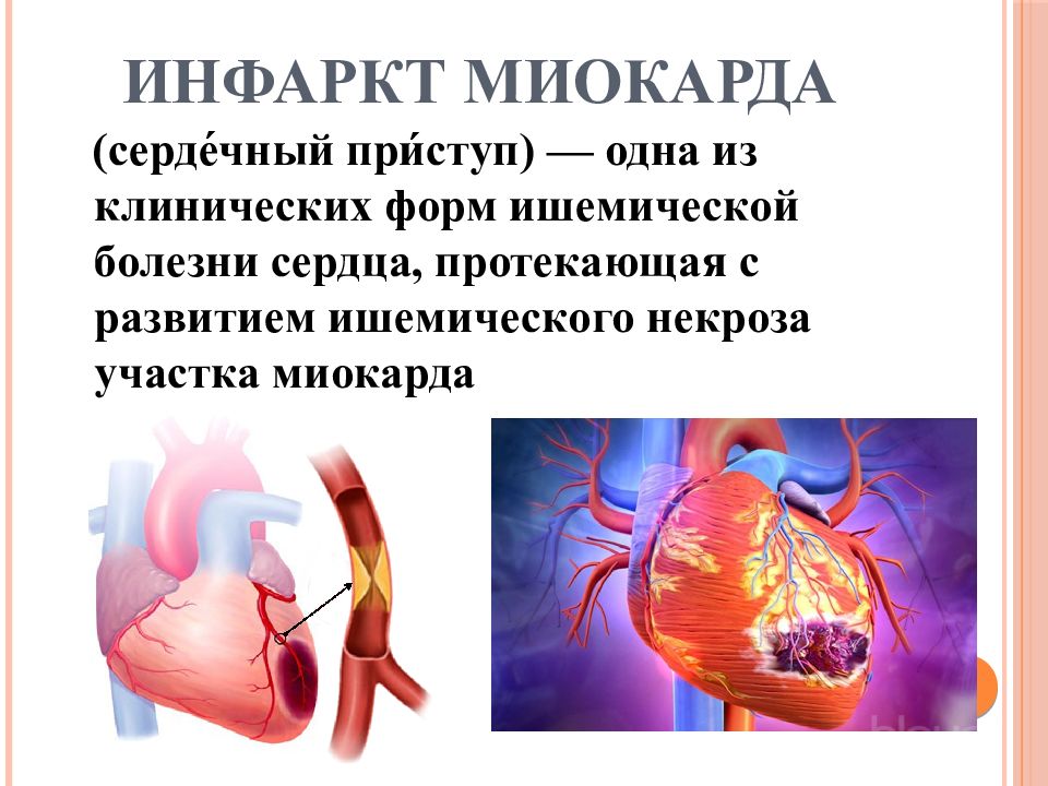 Инфаркт миокарда симптомы первые признаки и лечение. Формы ишемической инфаркт миокарда. Острый инфаркт миокарда симптомы.