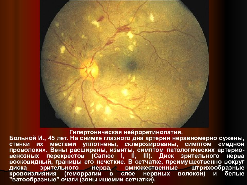 Гипертоническая ретинопатия презентация