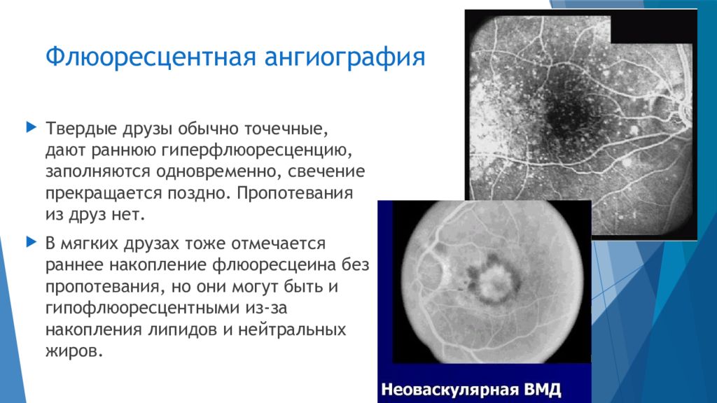 Возрастная макулярная дегенерация презентация