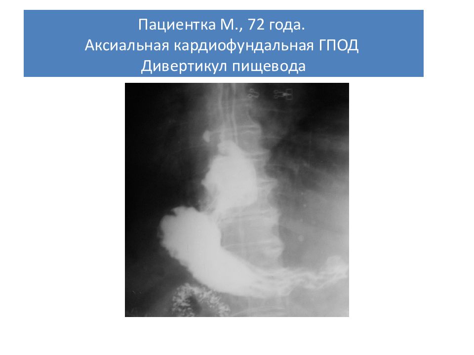 Грыжа пищеводного отверстия диафрагмы. Скользящая кардиофундальная грыжа пищеводного отверстия диафрагмы. Грыжа пищеводного отверстия диафрагмы рентген. Аксиальная грыжа пищевода рентген. Аксиальная кардиофундальная грыжа.