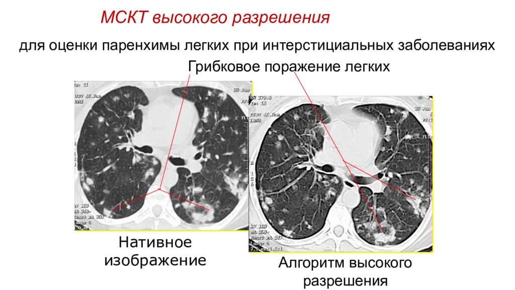 Презентация кт легких