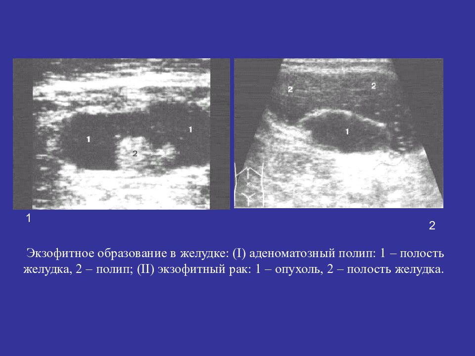 Экзофитный рак. Неопластические полипы желудка. Экзофитное образование. Экзофитное опухолевое образование. Аденоматозный полип желудка.