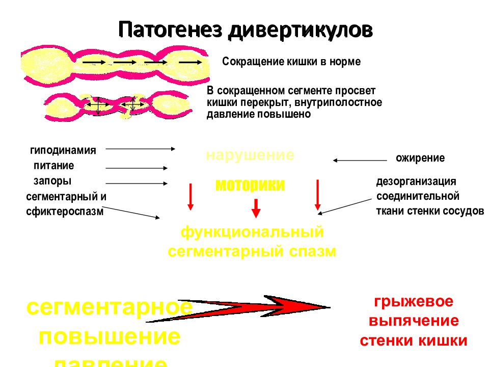 Схема лечения дивертикулита кишечника