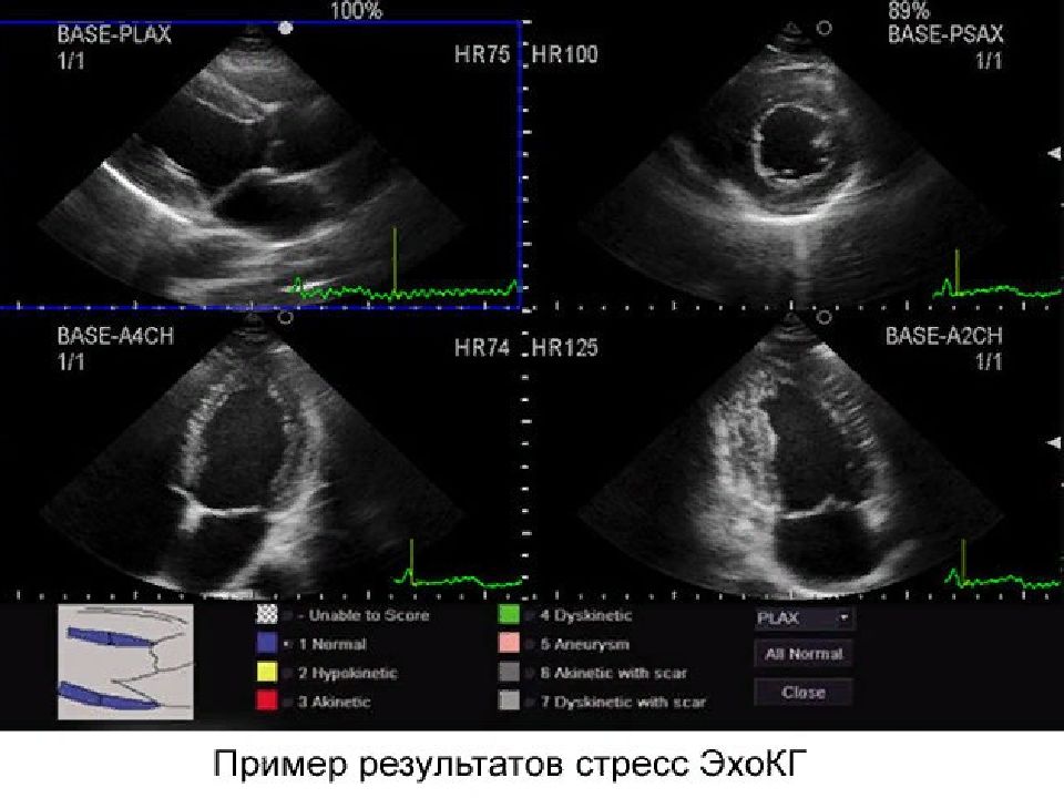 Стресс эхо кг презентация