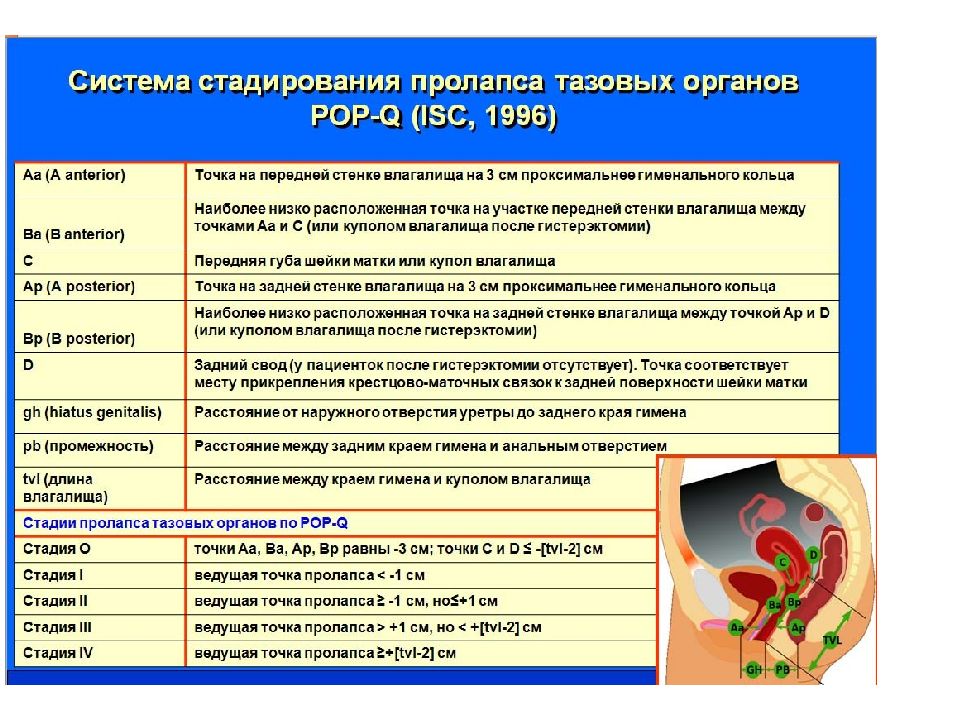 Опущение и выпадение матки презентация