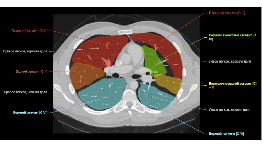 Кт клетки. Кт анатомия грудной клетки. Кт грудной клетки с обозначениями. Верхняя Апертура грудной клетки кт. Кт органов грудной клетки вид сбоку.