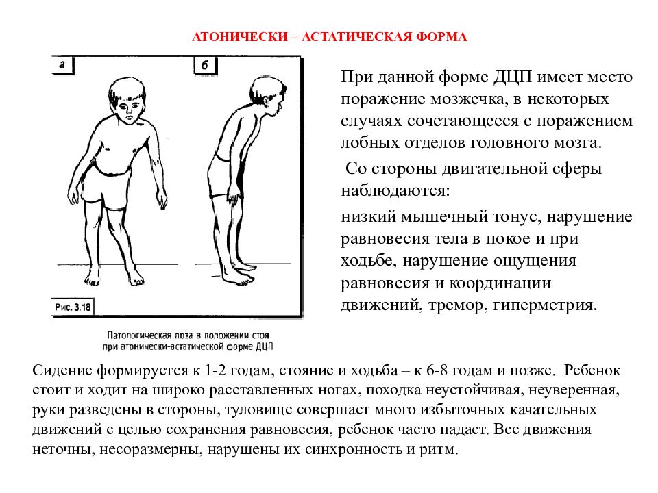 Дцп гиперкинетическая форма презентация