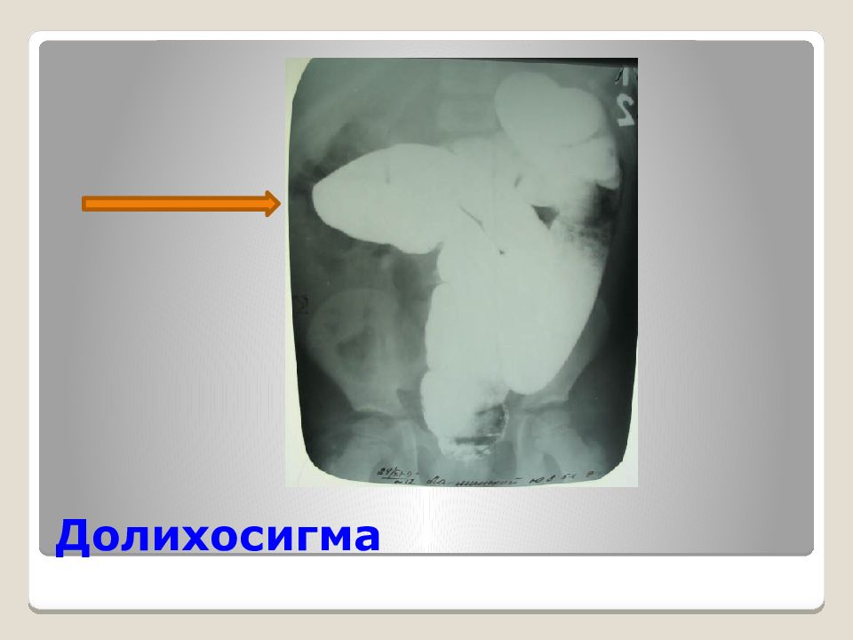 Долихосигма у детей фото