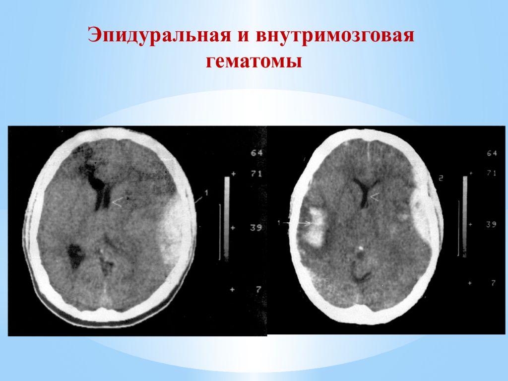 Черепно мозговая травма последствия. Внутримозговая гематома классификация кт. Внутримозговая гематома кт. Кт внутримозговая гематома головного мозга.