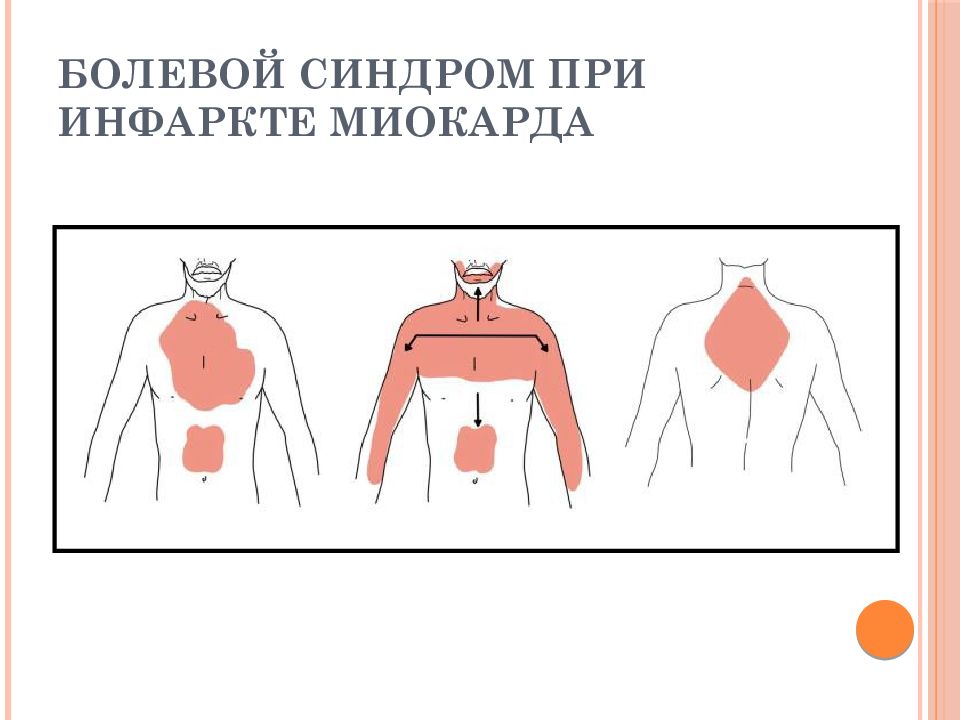 Тоны сердца при инфаркте миокарда. Иррадиация при инфаркте миокарда. Болевой синдром при инфаркте. Локализация боли при инфаркте миокарда. Локализация боли при стенокардии и инфаркте миокарда.