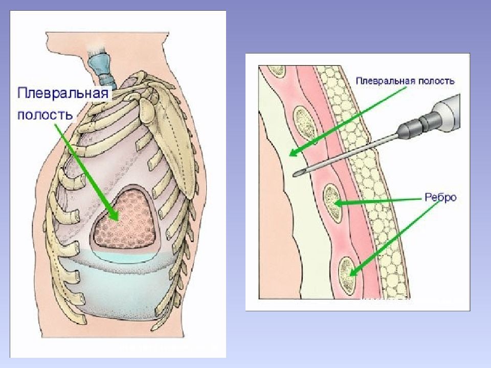 Плевральная пункция презентация