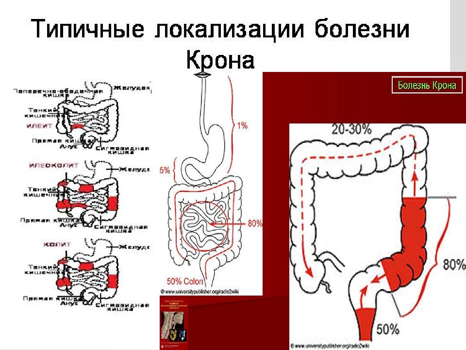 Клиническая картина болезни крона