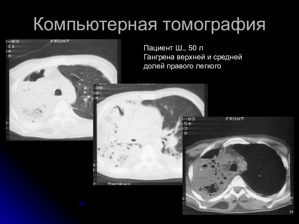 Абсцесс легкого презентация хирургия