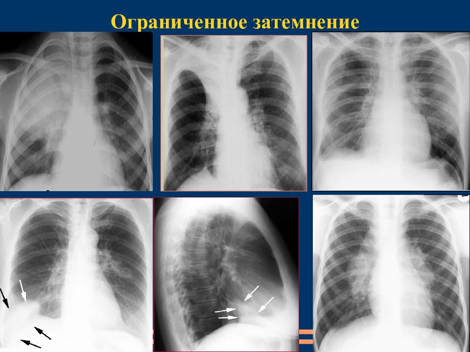 Затемнение на снимке. Синдром обширного затемнения рентген. Синдром ограниченного затемнения легкого. Синдром ограниченного затемнения легочной ткани. Затемнение легочного поля рентген.