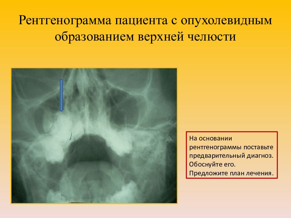 Доброкачественные одонтогенные опухоли презентация