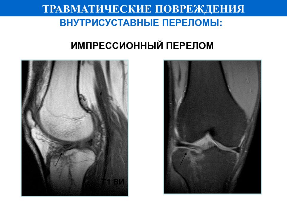 Импрессионный перелом. Импрессионный перелом большеберцовой кости. Импрессионный перелом мыщелка мрт. Импрессионный перелом мыщелка большеберцовой кости мрт. Перелом большеберцовой кости ИРТ.