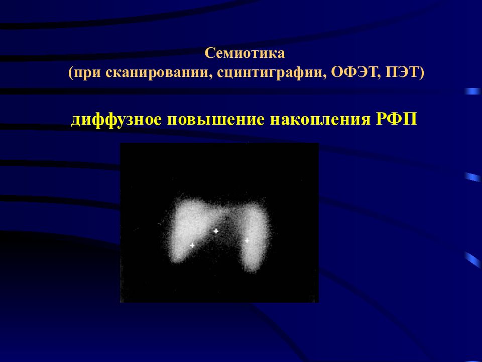 Радионуклидная визуализация. Радионуклидное сканирование. Сцинтиграфия. Сцинтиграфия картинки. Радионуклидная сцинтиграфия пищевода.