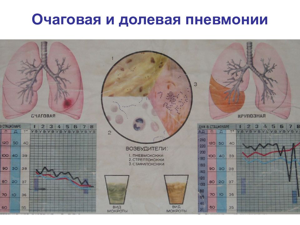 Пневмония очаговая презентация