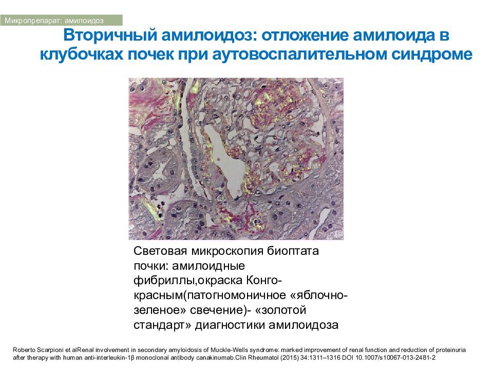 Амилоидоз почки рисунок