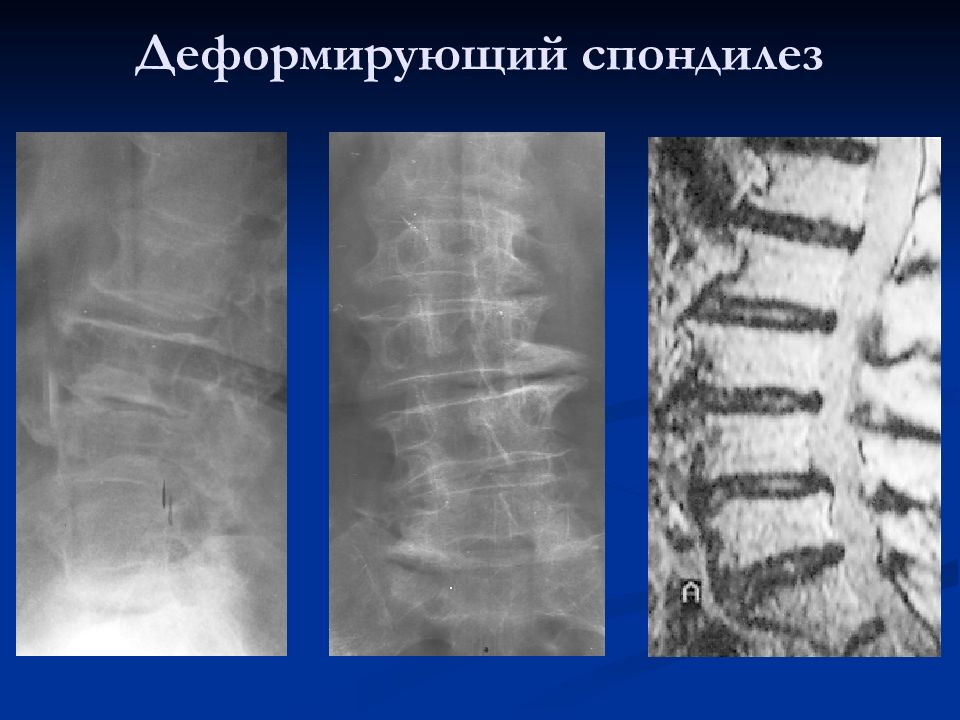 Спондилез 2 стадии