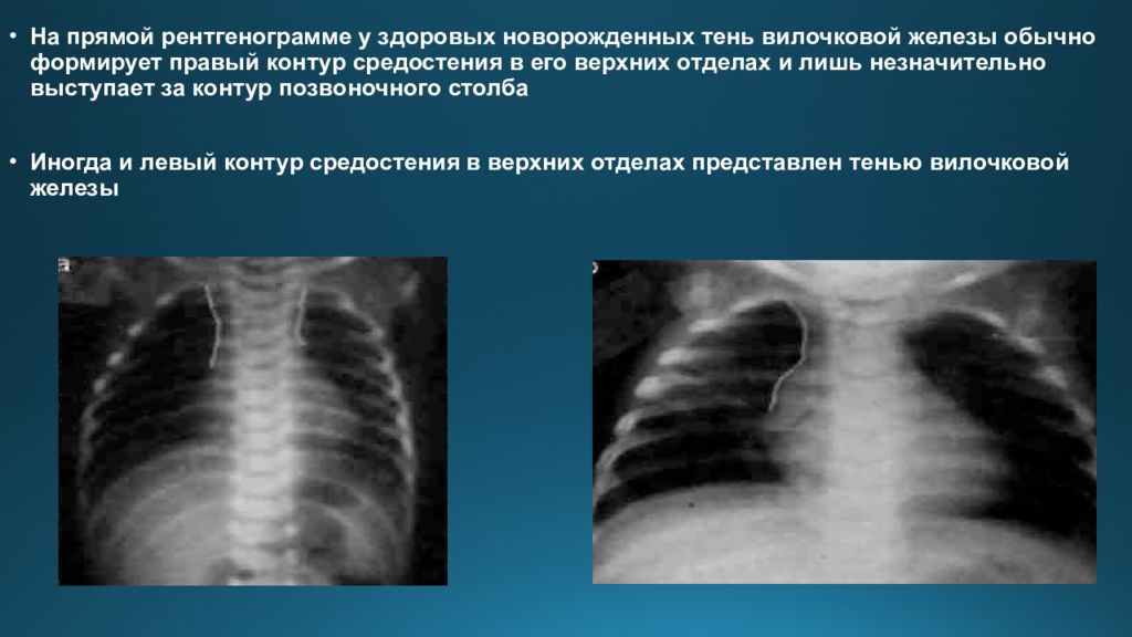 Лучевая диагностика органов средостения презентация