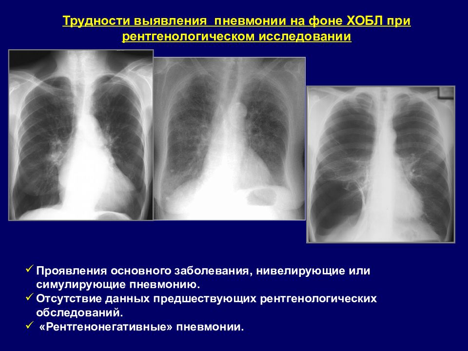 Рентгенологическая картина при хобл