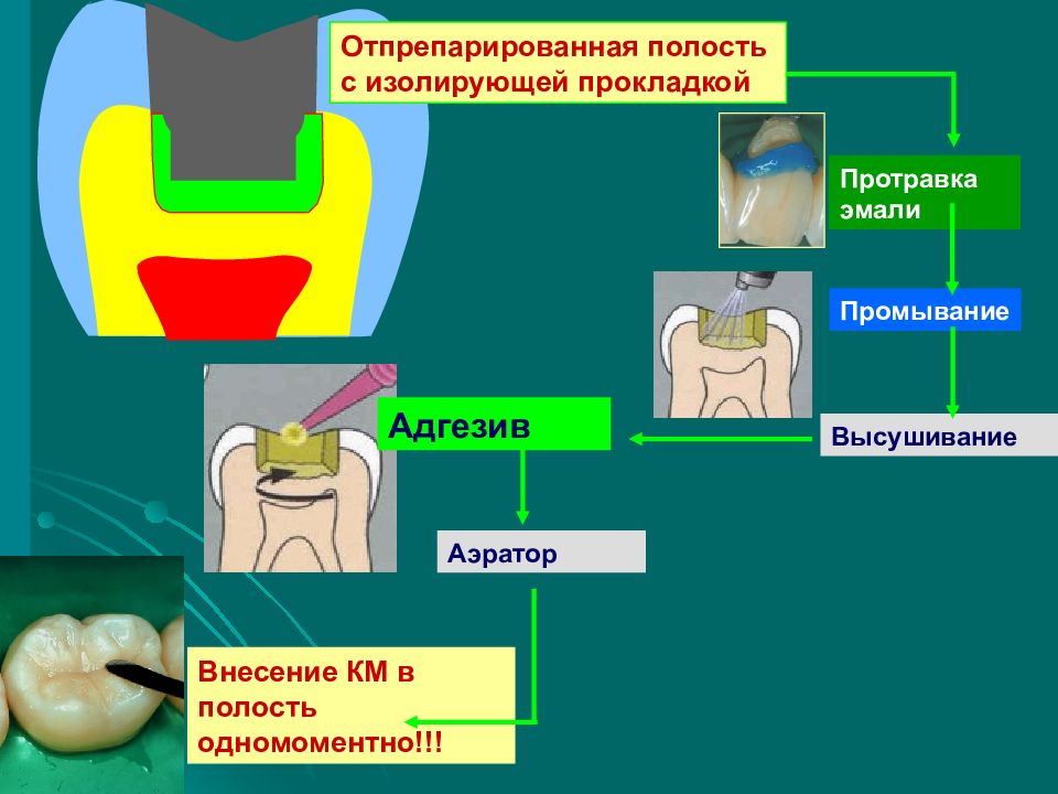 Полость средство. Изолирующая подкладка в стоматологии. Изолирующая прокладка зуб. Изолирующая прокладка в стоматологии на зубе. Базовая изолирующая прокладка.