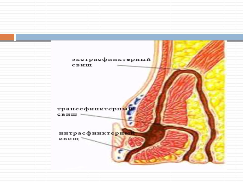 Транссфинктерный свищ прямой. Интрасфинктерный свищ прямой кишки. Экстрасфинктерные параректальные свищи.