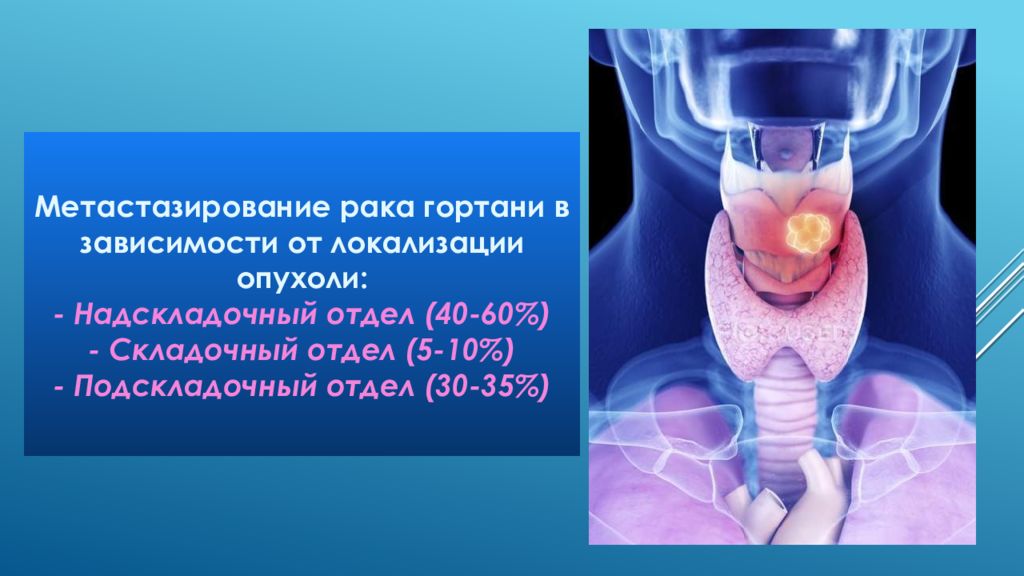 Рак Горла Стадии Фото