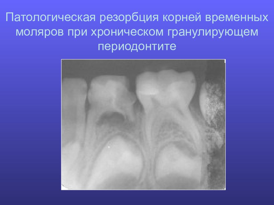 Периодонтит детская стоматология презентация