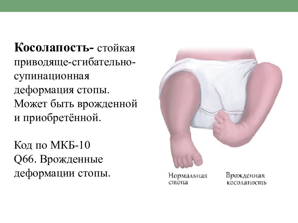 Врожденная косолапость картинки